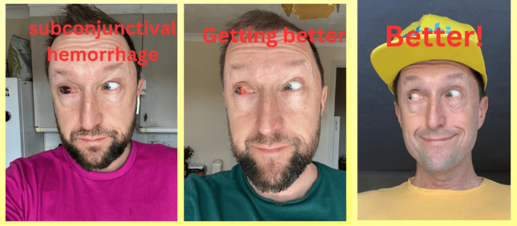 subconjunctival hemorrhage eye